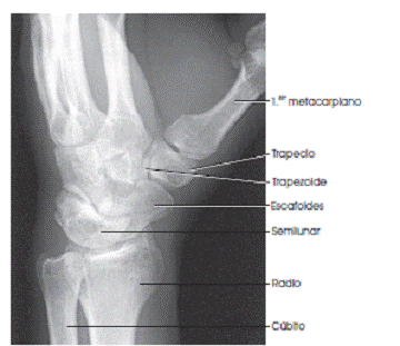 Oblique wrist projection